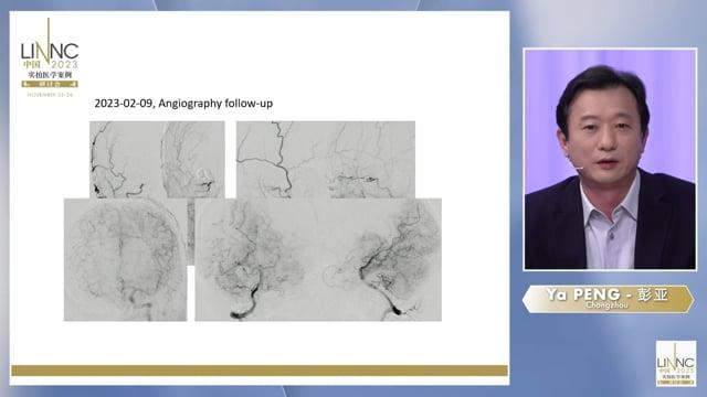 To do or not to do, a case of ICA-MCA Serpentine Aneurysm