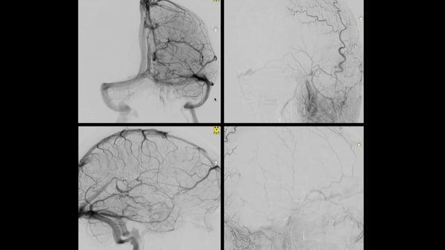 Trans-venous treatment of an indirect Carotid-Cavernous Fistula using Tetracoils and Phil