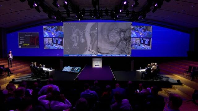 Incidental distal PICA Aneurysm treated with FD