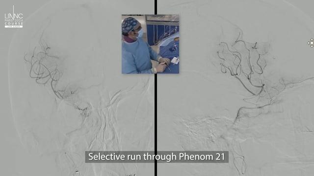Large stroke due to Right M1 occlusion treated with SR