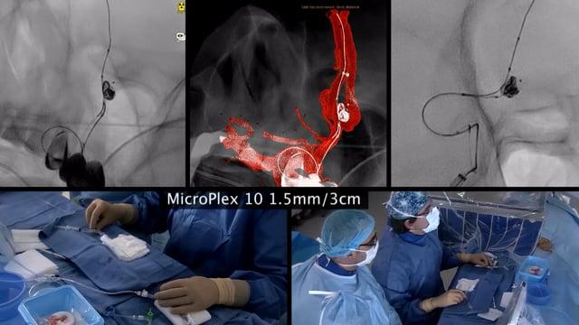 Recurrent initially ruptured ACOM aneurysm after intrasaccular FD device embolization, treated with coil remodeling and consecutive stenting