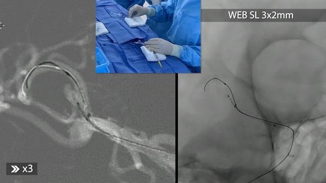 Treatment two unruptured homolateral MCA bifurcation aneurysms by 