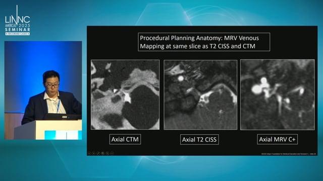 Endovascular treatment of Anterior Condylar Confluence CSF-Venous Fistula