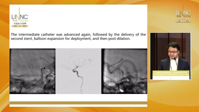 A Case of Treating a Carotid Cavernous Fistula with Willis Covered Stent and Trojan Horse Technique