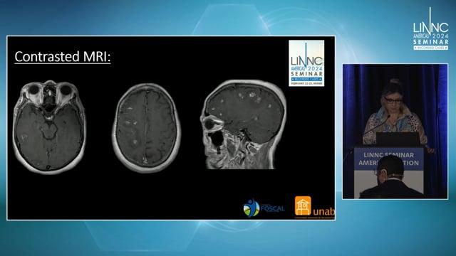A NICE (Non-ischemic Cerebral Enhancing) case