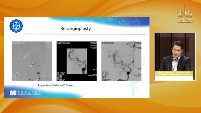 Interventional treatment of the right middle cerebral artery aneurysm with proximal stenosis