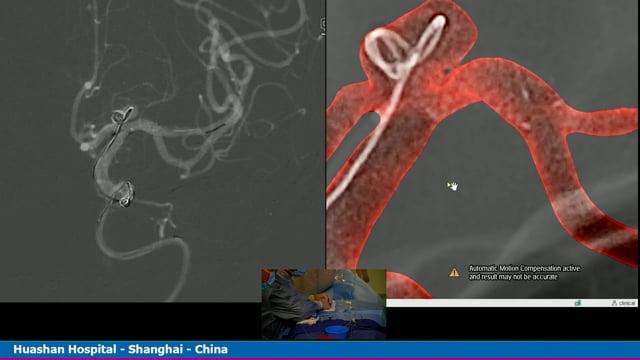 SAC for left ACA(A1)Aneurysm