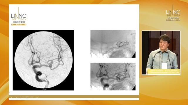 Staging compound treatment of complex middle cerebral aneurysm