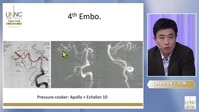Modified pressure cooker technique in embolization of bAVM