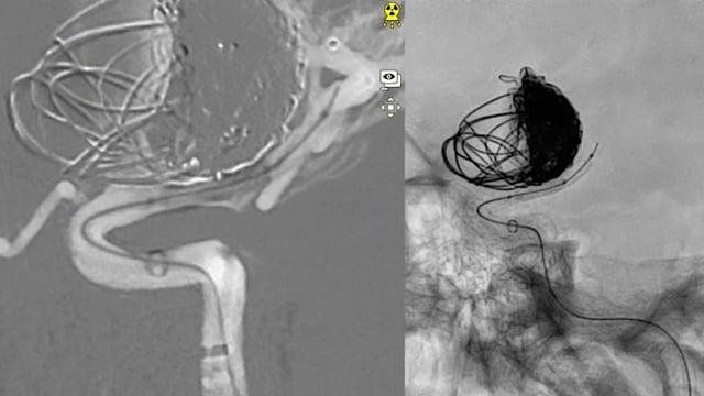 Classic M2 thrombectomy