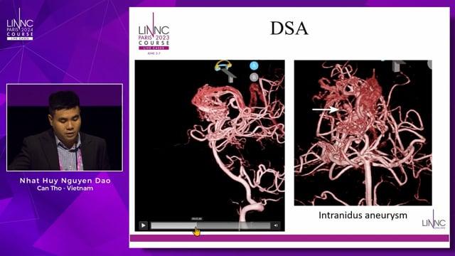 Ruptured deep cerebral arteriovenous malformation: Weakness is the target