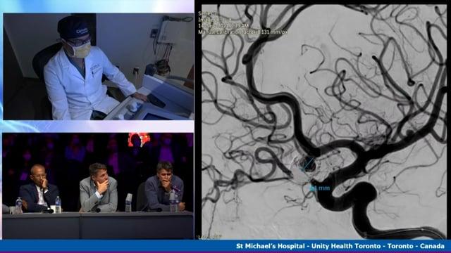 Recanalized Acom Aneurysm Treatment. Robotic Stent Assisted Coiling (braided stent)