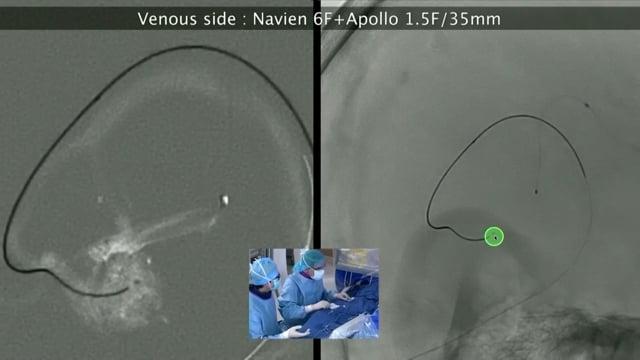 Management of a ruptured left temporal Arteriovenous Malformation with venous approach 