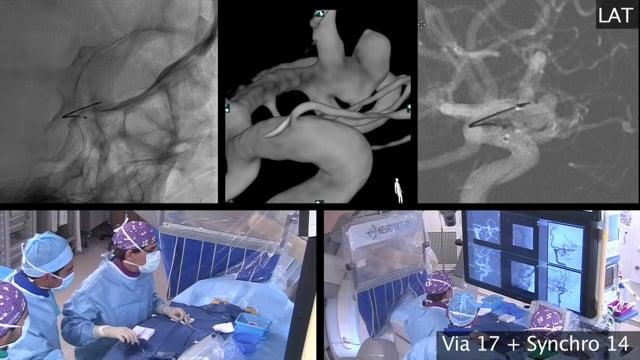 Balloon-remodeling-assisted WEB treatment of a complex bifurcation aneurysm 