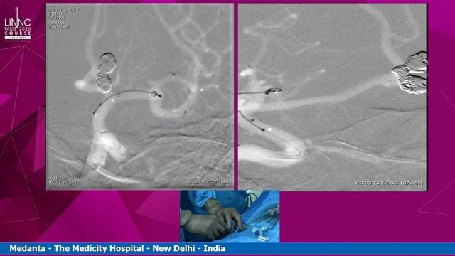 Left MCA bifurcation aneurysm