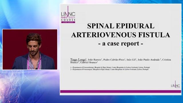 Spinal Epidural Arteriovenous Fistula - a case report