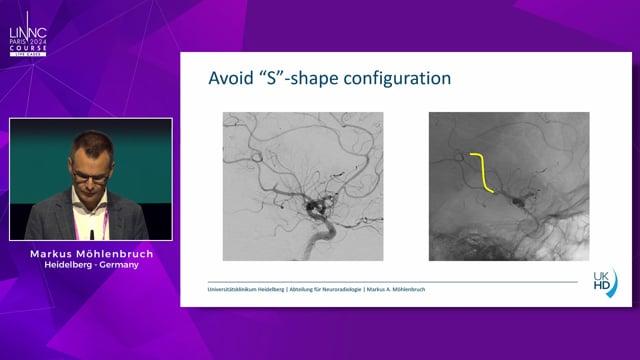 Differences in the recanalization techniques of LVOs and MeVOs