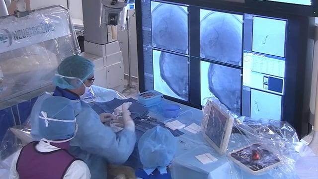 Acomm aneurysm web treatment