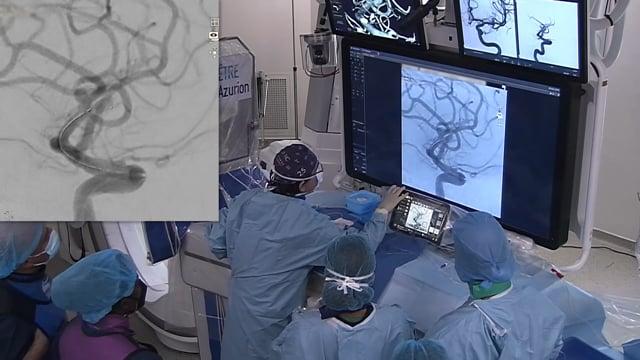 Artisse device in an MCA aneurysm