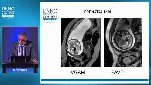 From pial arteriovenous fistula (PAVF) to nidal AVM, same treatment?