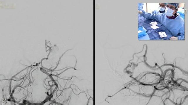 Transarterial embolization of the remant of a previous ruptured parietal AVM with a non adhesive liquid embolic