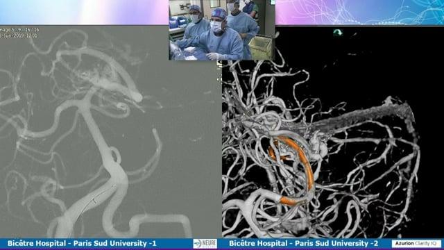 A double arterial and venous approach for treating a complex AVM 