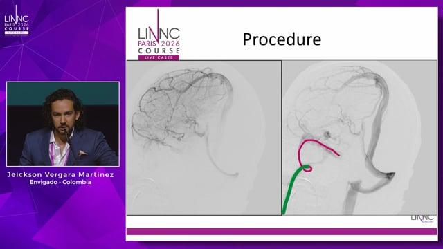 A venous anomaly beyond convention: the other face of DVAs