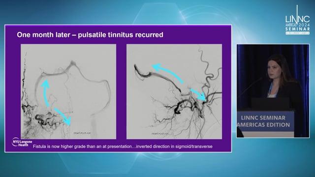 Pipeline Stent as a Solution for Recurrent Sigmoid Sinus DAVF