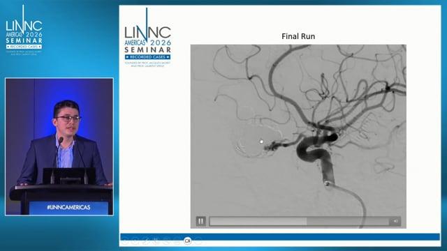 Pure Intraorbital AV Fistula, Management with Transvenous Embolization